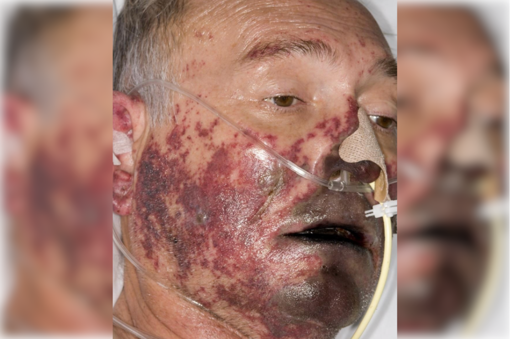 Jaco's face is pictured during his hospital stay with sepsis. He has an oxygen supply tube wrapped round his ears going into his nose, and his skin is severely mottled and darkened.