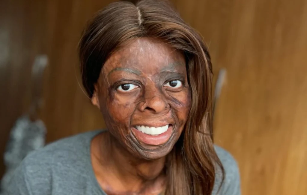 Woman smiling at camera wearing gray shirt with visible facial scarring, against brown wooden background.