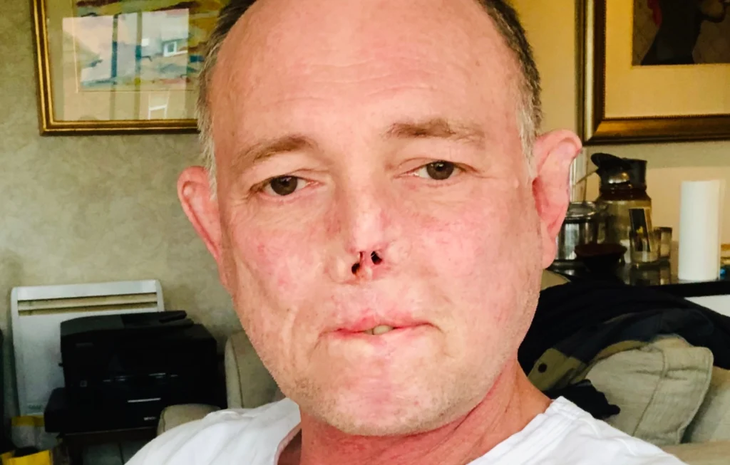 Man with visible facial scarring on nose and upper lip area, wearing white shirt in home setting.