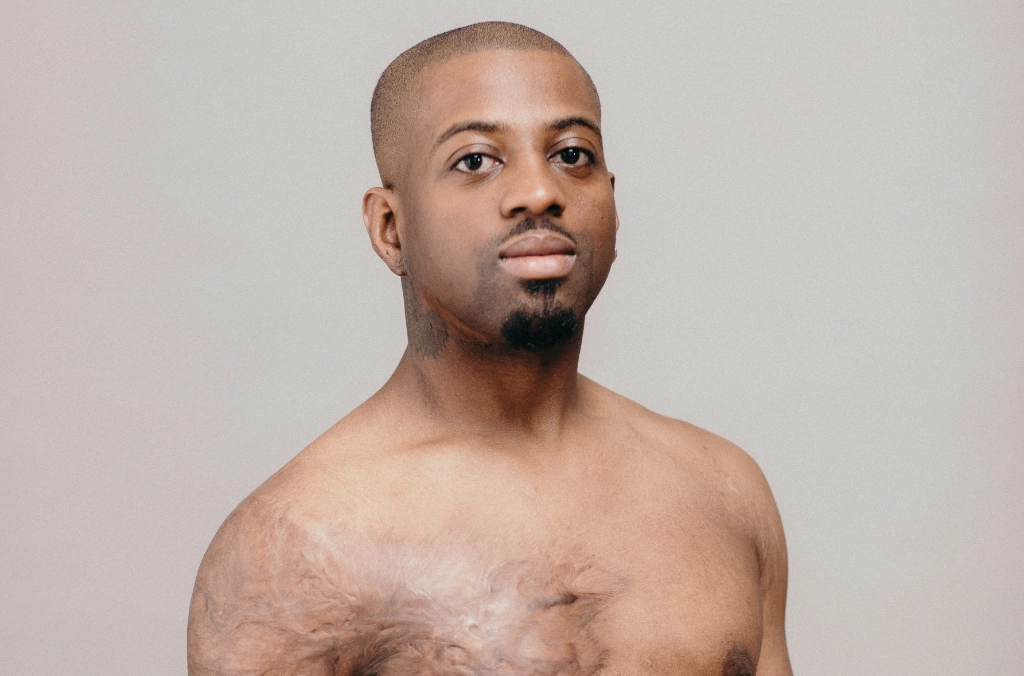 Shirtless man with chest scars against gray background, looking at camera for medical charity foundation.