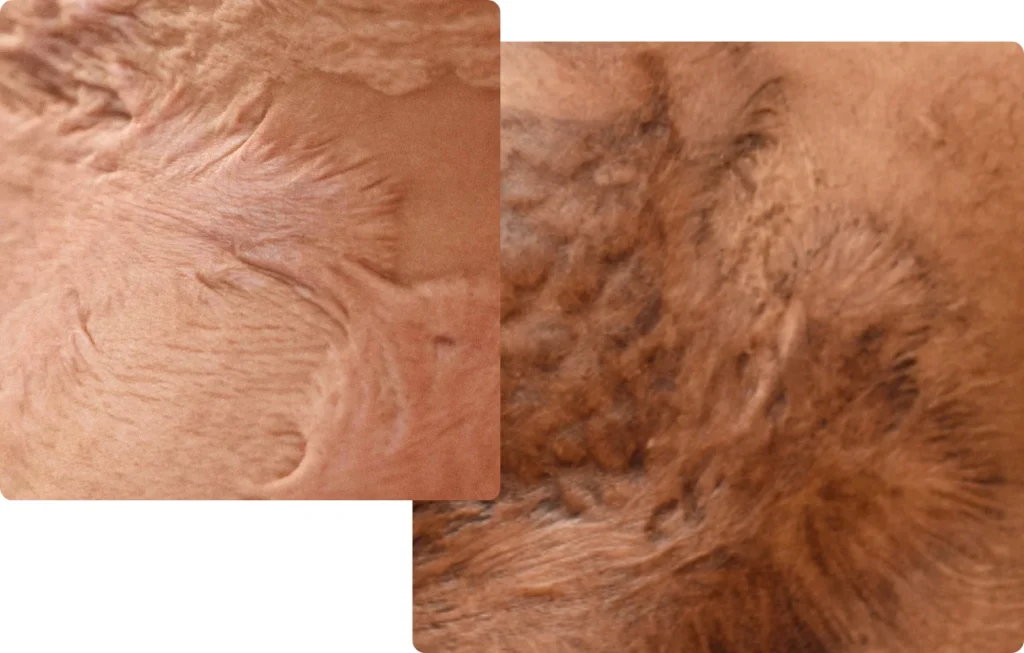 Two views of Contracture scars