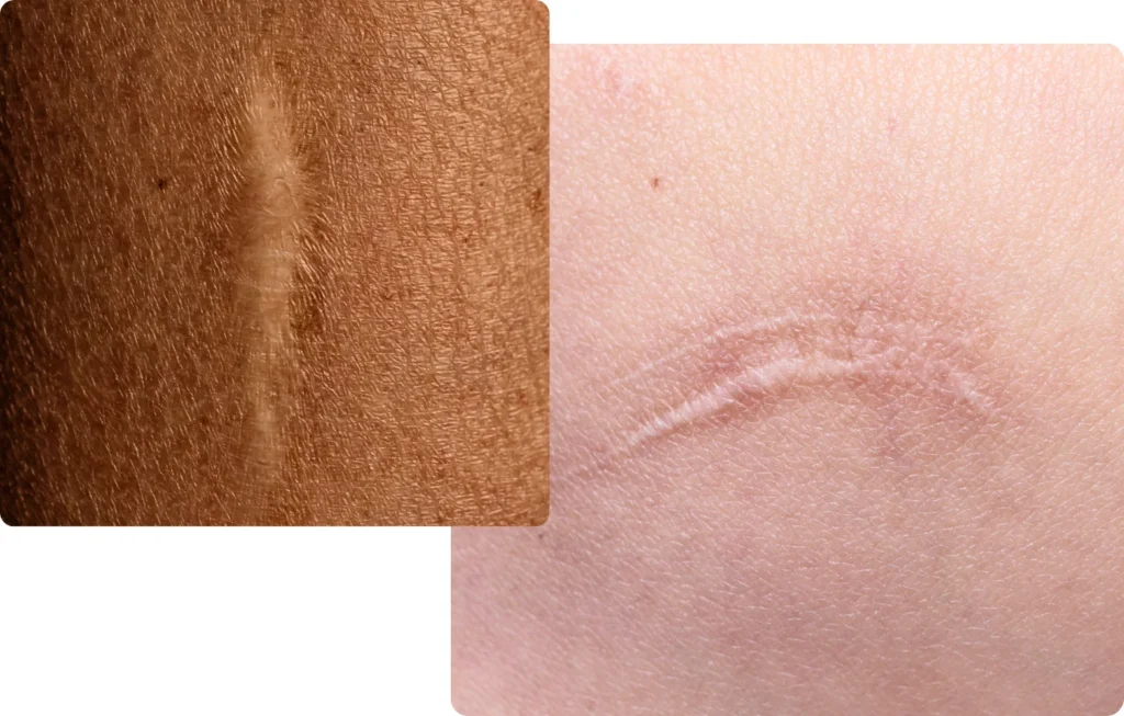 Examples of Fine-line Scars