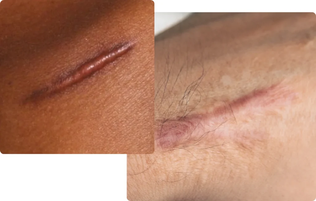 Hypertropic scar examples