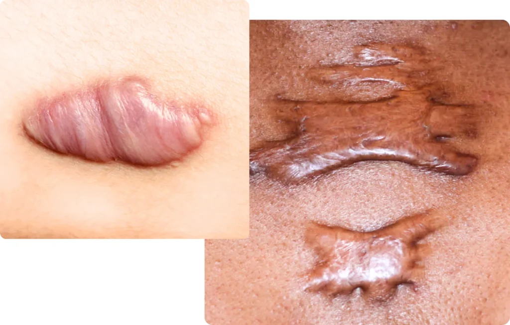Examples of scar Keloid