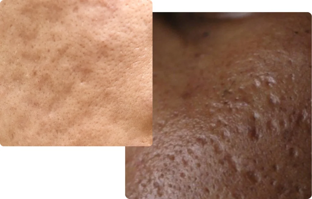 Examples of atrophic scars