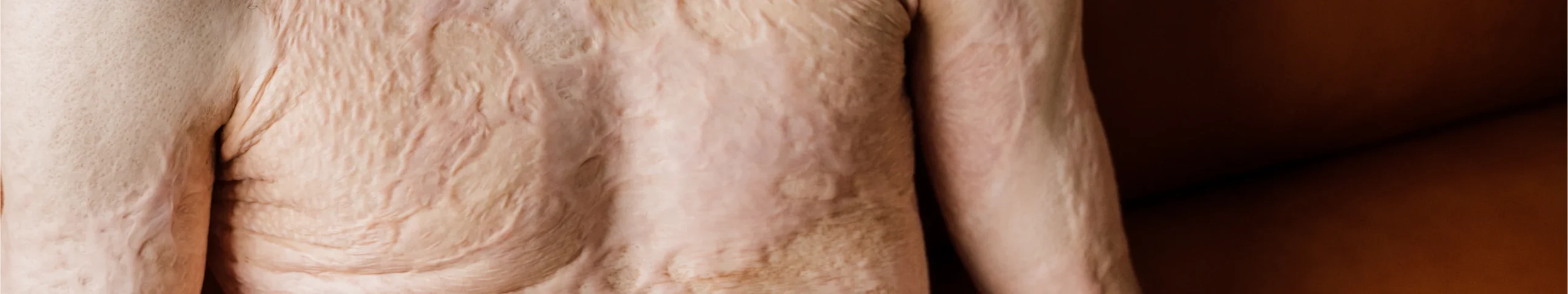 Mans scarred chest and arm