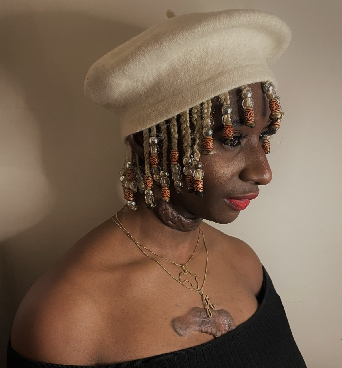 Ada stands against a beige background in profile to the camera. Ada wears a cream beret, and a black off the shoulder top. Ada has a keloid scars on her neck and on her chest.